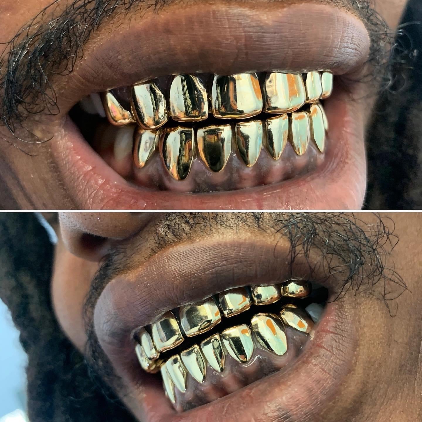14 Karat Gold ($285 per tooth)