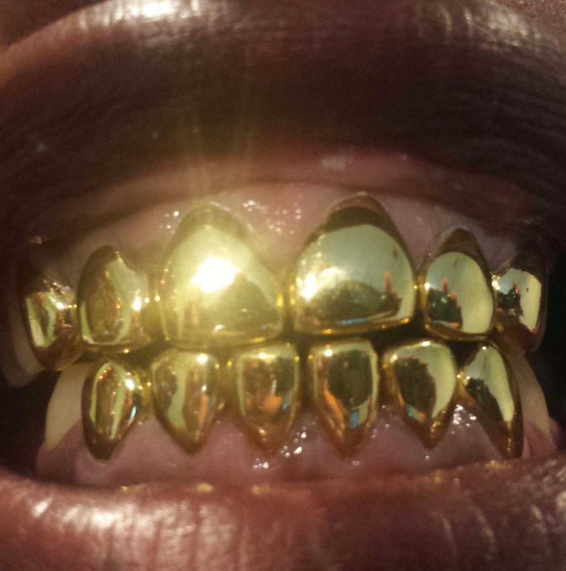 22k Gold (Permanent Crown)