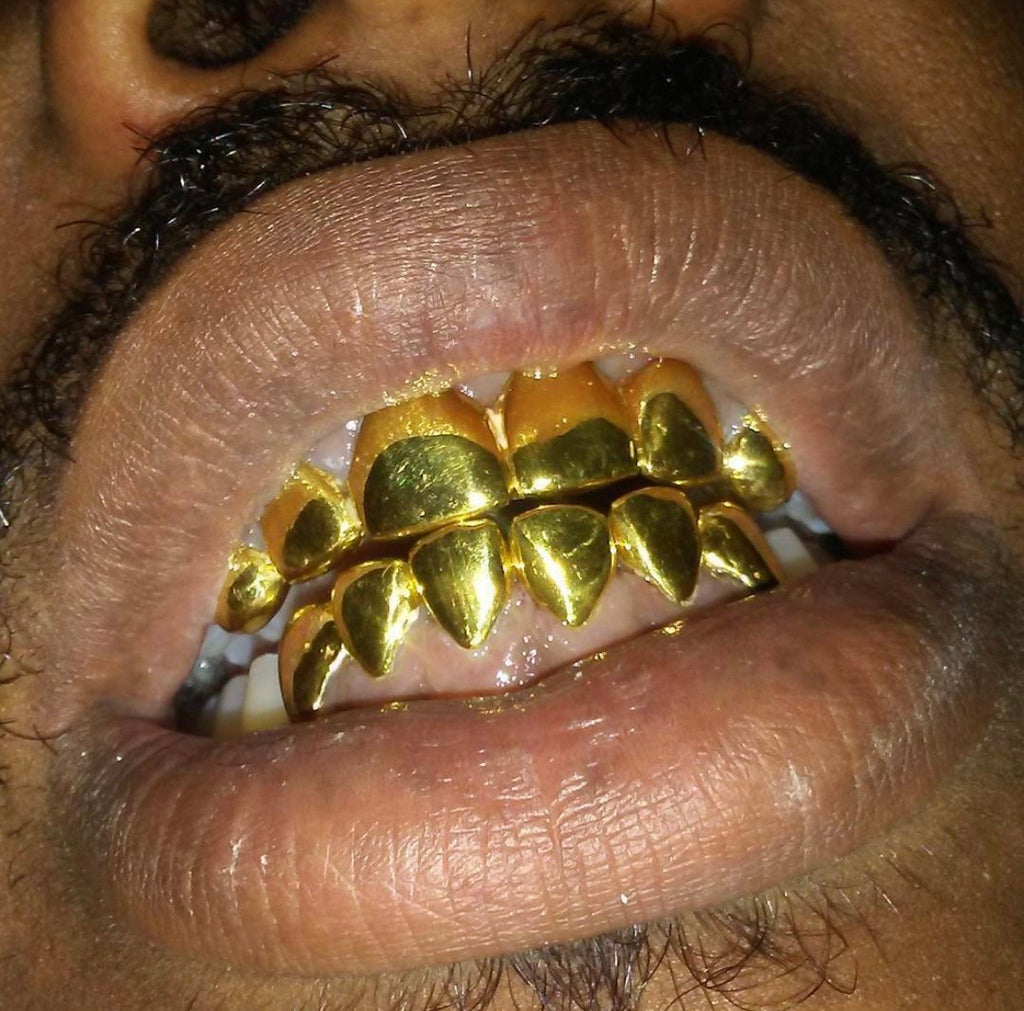 22k Gold (Permanent Crown)