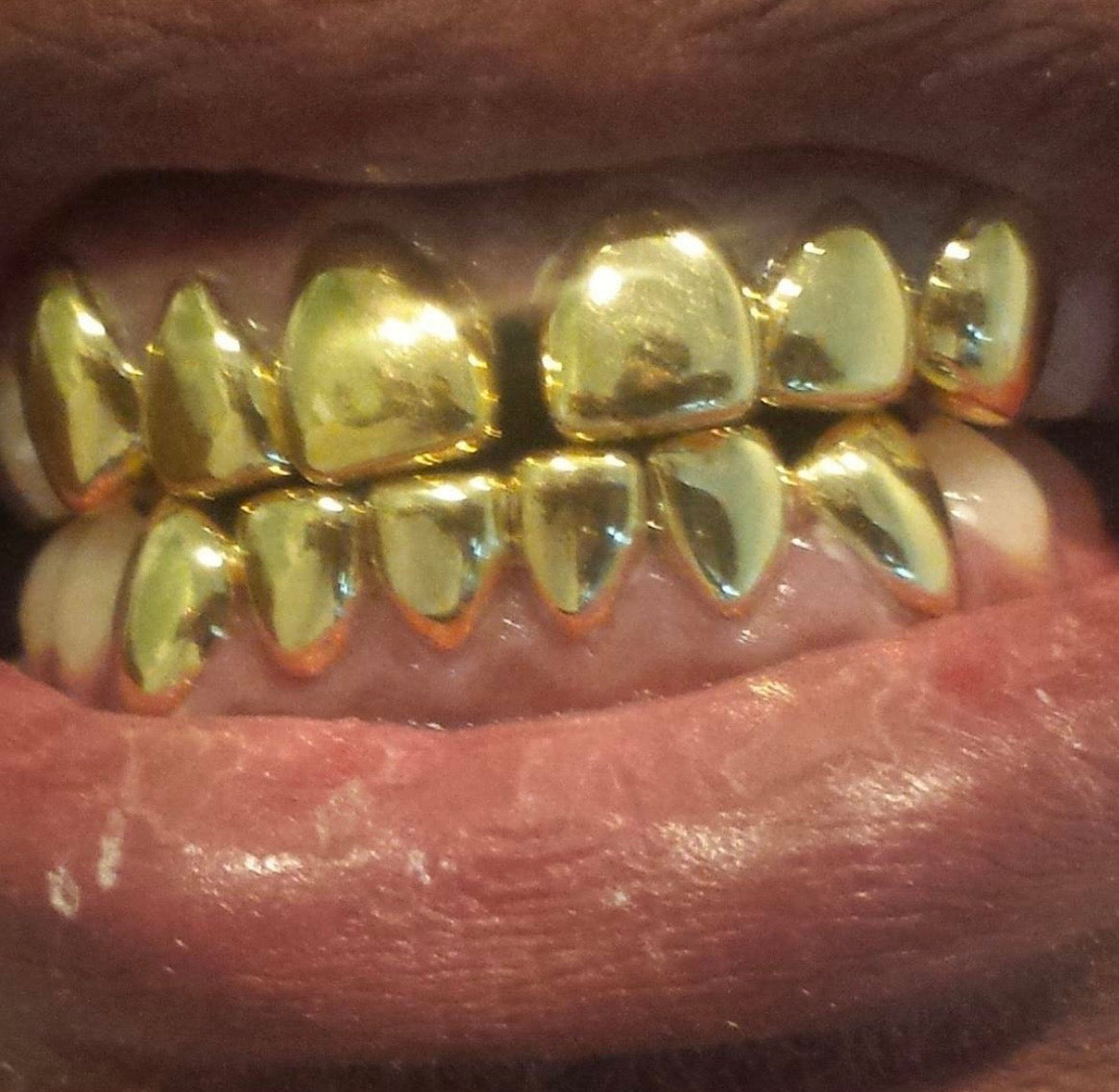 22k Gold (Permanent Crown)
