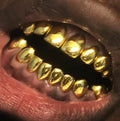 22k Gold (Permanent Crown)