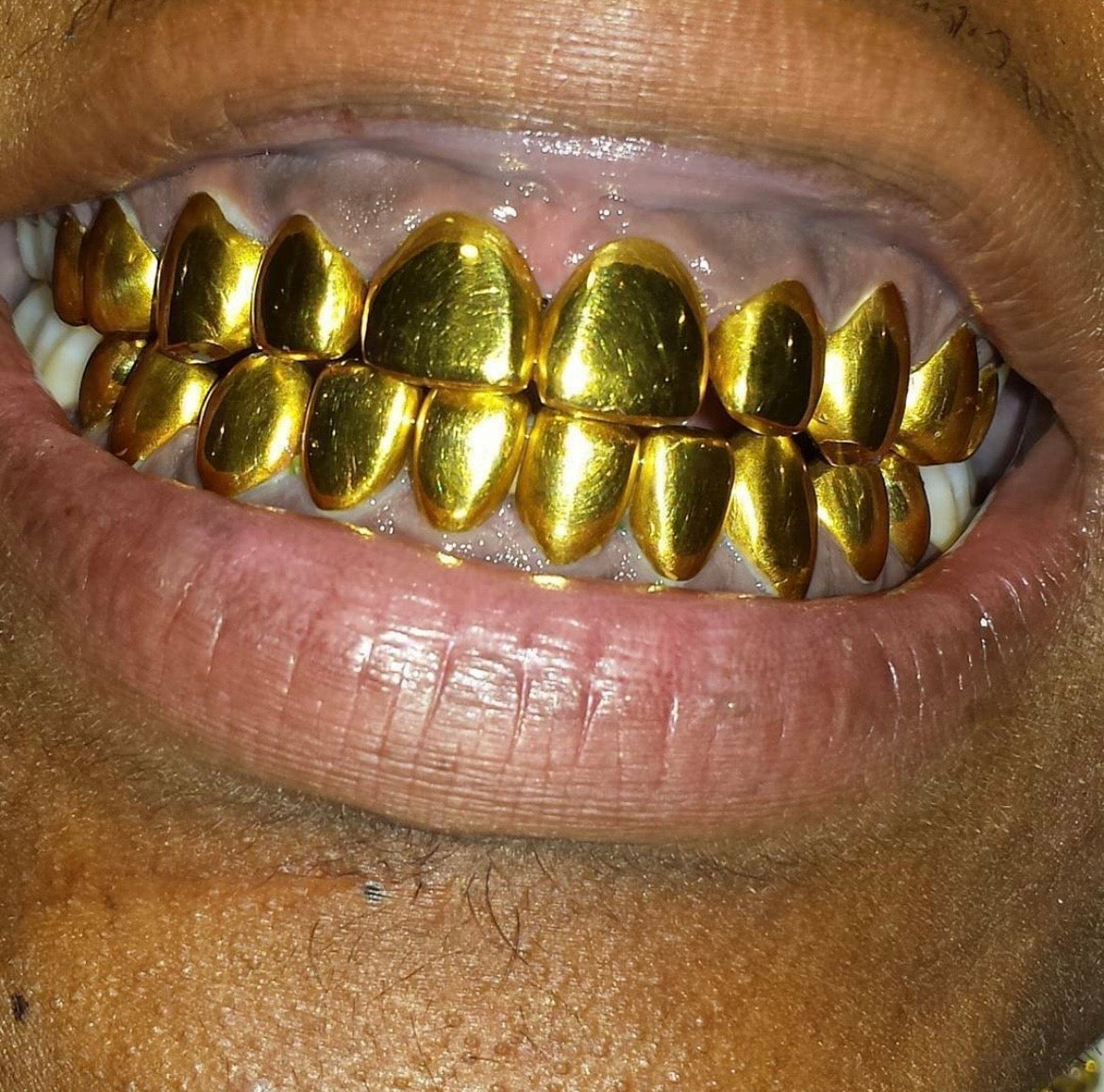 22k Gold (Permanent Crown)